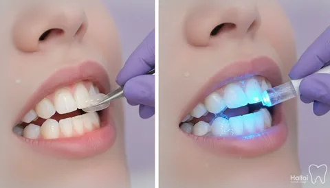 Veneer vs. Bleaching: Mana yang Tepat untuk Senyum Anda?