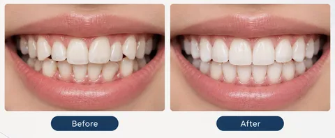 Invisalign