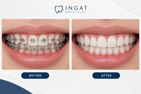 BRACKET/KAWAT GIGI